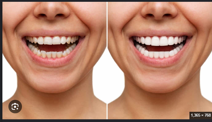 Laser teeth whitening 